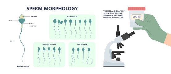 in vitro fertilization IVF semen test sample sperm count type Male biopsy fertility collect Low Poor Zero head anatomy midpiece tail birth control blocked defect abnormal ejaculate vas Non dry