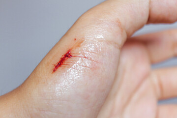 hand with a cut on the hand
