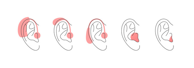 Deaf and hear aid concept. Vector flat illustration set. Collection of hearing aid device in outline human ear silhouette isolated on white. Design element for medicine, health care. - Powered by Adobe