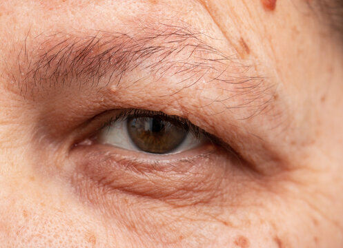 Wrinkles Around The Eyes On A Woman's Face