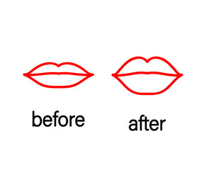 Lips before and after botox injection. Symbol. Vector illustration.