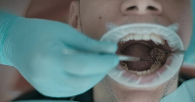 A patient&rsquo;s mouth full of saliva is wide open while the dentist is examining his teeth with the help of a dental mirror and a dental probe.