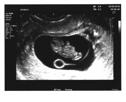 Early pregnancy viability scan