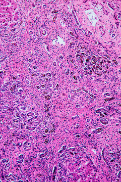 ill human liver cells of biliary cirrhosis