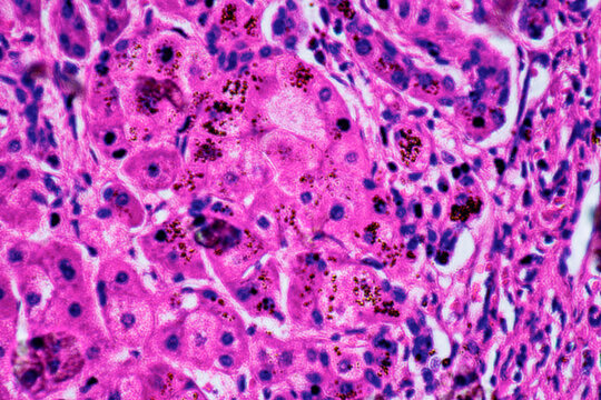 ill human liver cells of biliary cirrhosis