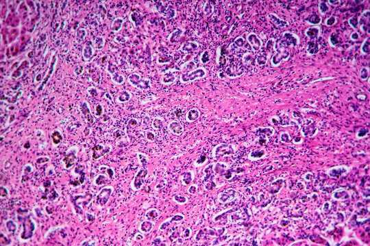 ill human liver cells of biliary cirrhosis