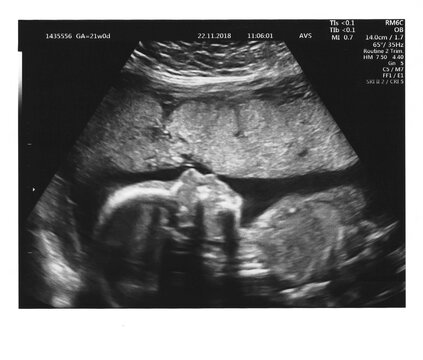 Sonogram of babys profile