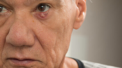 Man with a huge stye on his eyelid 