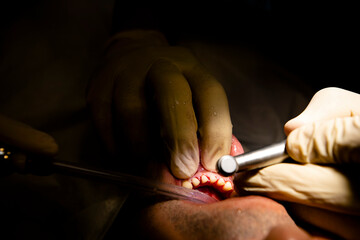 Close up dentist teeth operation 