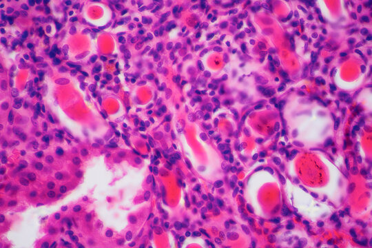 kidney of patient with hypertension