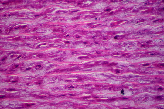 Main artery atherosclerosis human cells