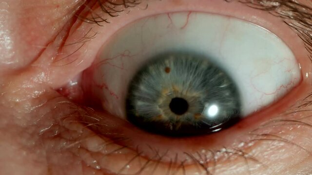 MACRO: Opened bulging human eye, Close shot