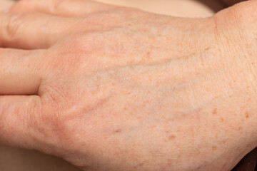 veins on the skin of the hands