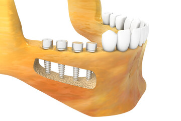 Dental implant installation process. 3d illustration