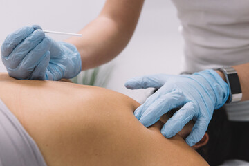Doctor hands on a dry needling therapy - 420703627