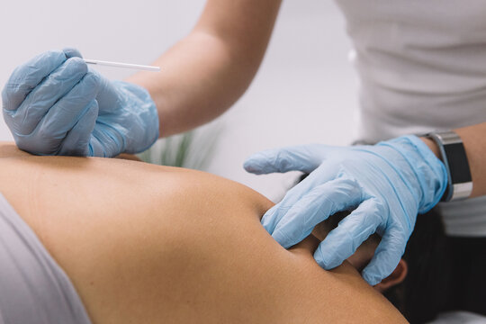 Doctor hands on a dry needling therapy