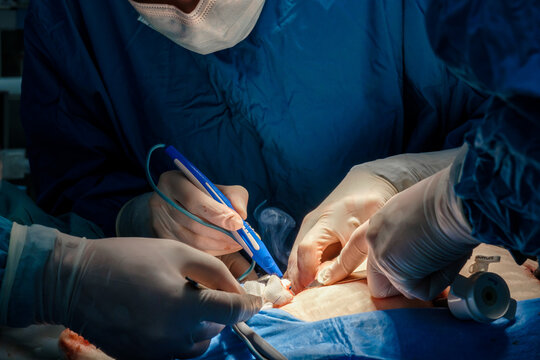 The surgeon holds the electrical coagulator during the operation. Close-up of hands in sterile gloves stained with blood. Blue uniform and medical masks. Smoke from burnt flesh.