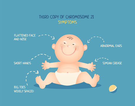 Down syndrome. Symptoms. Happy cute baby boy with trysomy 21. Poster for world down syndrome day on 21 march. Infographic.