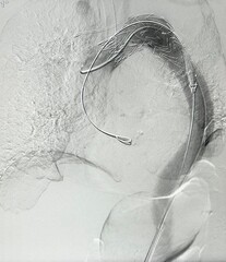 Angiogram of  Thoracic endovascular aortic repair (TEVAR).	
