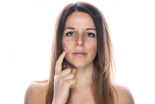 Young Woman With Problem Skin Applying Treatment Cream On White Background - Concept About Skin Care