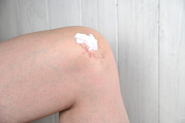 Warming ointment applied in a thick layer to the injured knee.