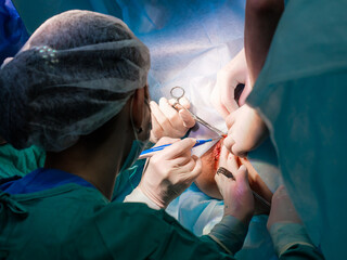 The surgeon holds the electrical coagulator during proctological surgery on the anus. Close-up -...