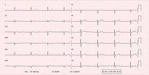 ECG example of a bradycardia 12-lead rhythm