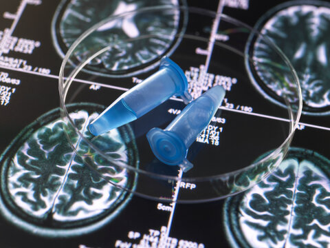 Clinical samples from research project contained in vials with brain scan images, research into Alzheimers and dementia medical conditions.