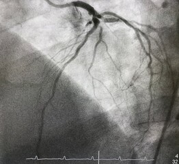 Coronary angiogram shown left anterior descending artery (LAD) stenosis during cardiac catheterization.