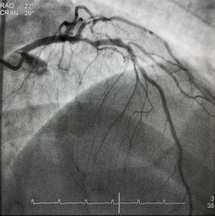Coronary angiogram shown left anterior descending artery (LAD) stenosis during cardiac catheterization.