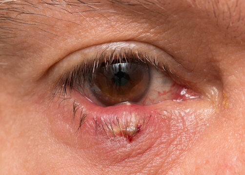 Man with a huge stye on his lower right eyelid