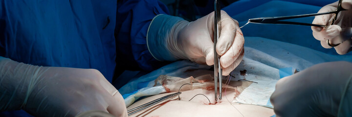 Doctors in blue uniforms use medical instruments and metal thread to suture human skin during...