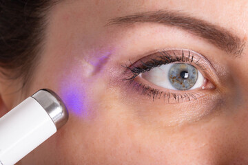 Cosmetological procedure laser resurfacing of scars on the skin. Concept of a modern scar removal...
