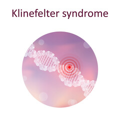 Klinefelter syndrome. Genetic. DNA double helix. Medical illustration.