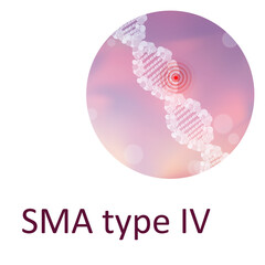 SMA type IV. Spinal muscular atrophy. Genetic. DNA double helix. Medical illustration.