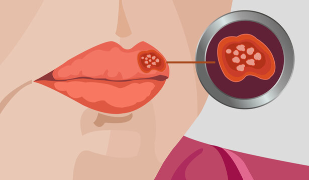 Herpes simplex virus on lip close up illustration