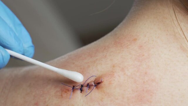 A doctor treats a wound on a woman's shoulder. Consequences of breast surgery, laparoscopy.