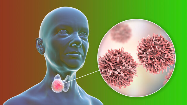 Thyroid cancer, illustration showing tumor inside thyroid gland and closeup view of cancer cells