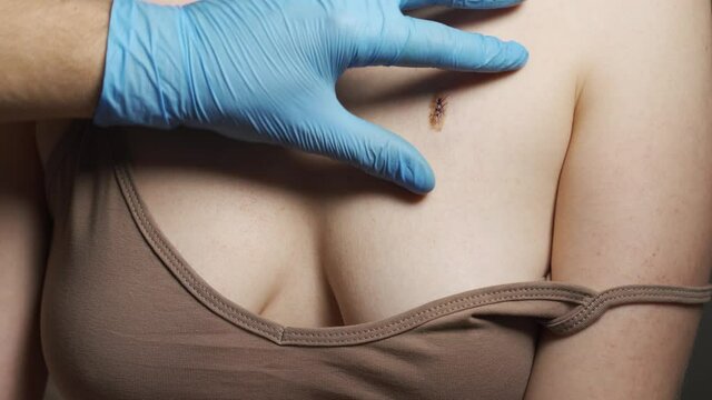 Removing thin stitches from surgical wound HD.