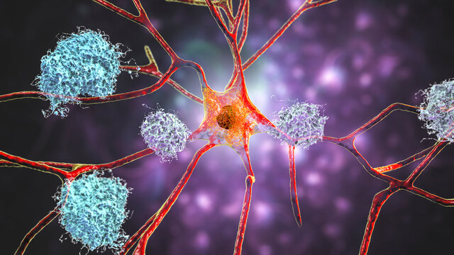 Neurons in Alzheimer's disease. Illustration showing amyloid plaques in brain tissue
