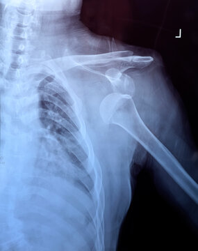 X-ray of shoulder joint show fracture clavicle