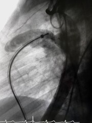 Aortography showed patent ductus arteriosus (PDA) during PDA closure device via endovascular procedure.