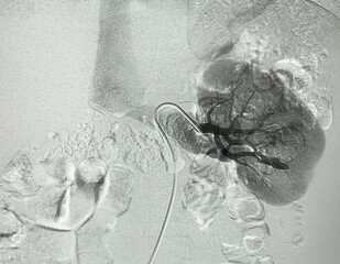 Angiogram shown renal artery rupture with bleeding around lesion