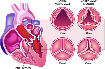 Medical illustration shows the difference between a normal aortic valve and one with stenosis, open and closed, and its location in the heart, with annotations.