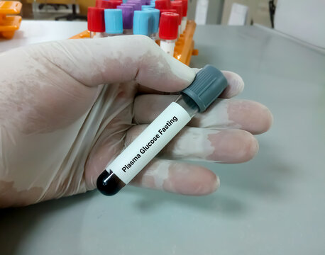 Technician or scientist hold a sample tube of Plasma glucose Fasting (FGP) test. Fasting blood sugar(FBS) for diagnosis hyperglycemia or hypoglycemia in Diabetes Mellitus (DM).Medical testing concept