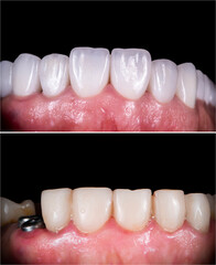 creating new smile by implants , zirkonum crowns and veneers
