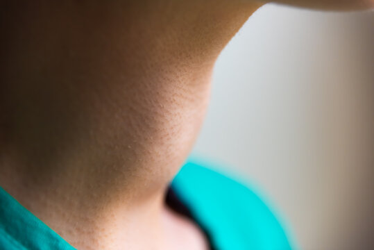 Macro closeup portrait of young woman neck profile with Grave's disease hyperthyroidism symptoms of enlarged thyroid gland goiter