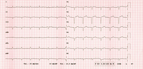 ECG 12-lead rhythm, example of rare pathology Amyloidosis