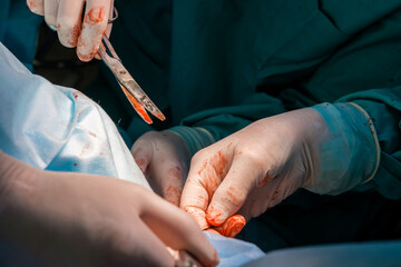 Surgeons use medical instruments to perform a proctological minimally invasive operation on the...