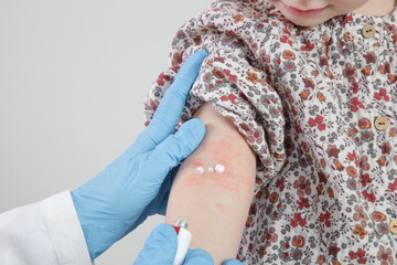 Doctor applaying ointment onto red and itchy eczema on kid's arm. Toddler girl suffering from...